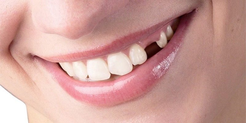 Luận Giải Giấc Mơ Thấy Răng Rụng Và Tìm Dàn Lô Đẹp